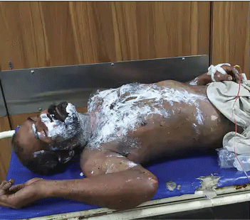A Man Set Fire Himself Outside The Police Station In Panchkula