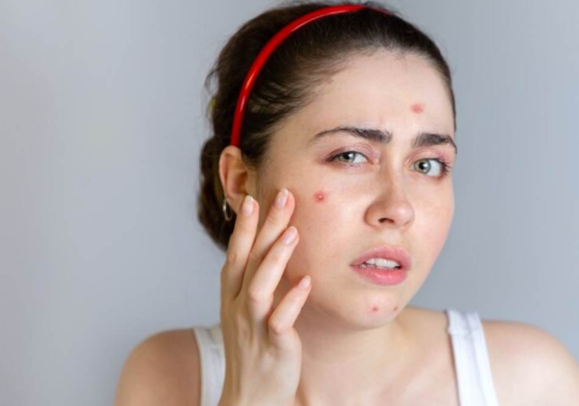 Pimple Home Remedies