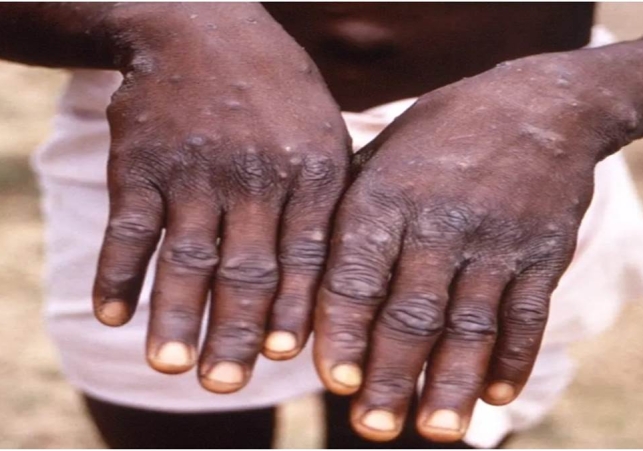 Monkeypox या COVID-19 में कौन सा वायरस अधिक खतरनाक? जानिए- एक्‍सपर्ट की सलाह