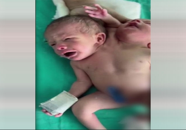 A woman gave birth to a baby having two heads and three hands in Ratlam Madhya Pradesh 