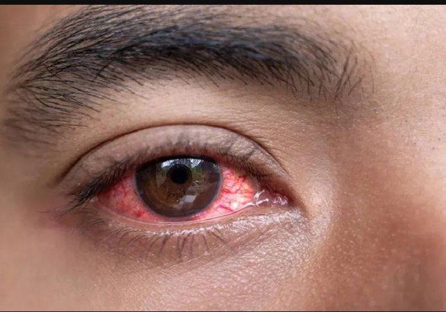 Eye Flu Cases
