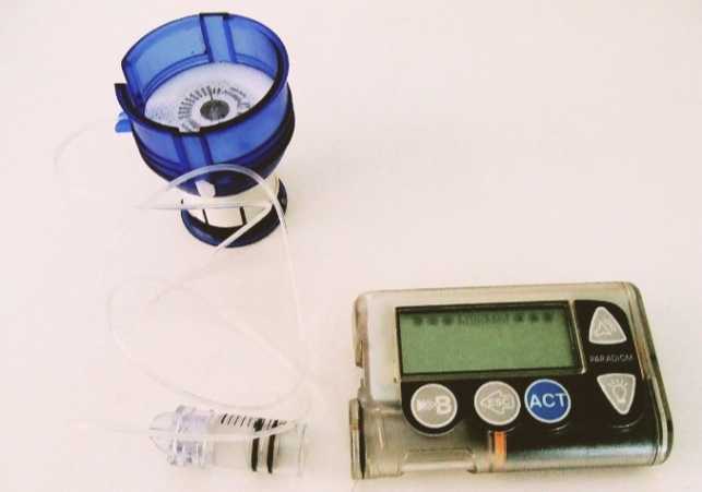 Insulin pump introduced for type-a diabetes