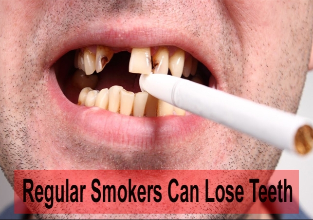 Regular Smokers Have Higher Risk to Lose Teeth 