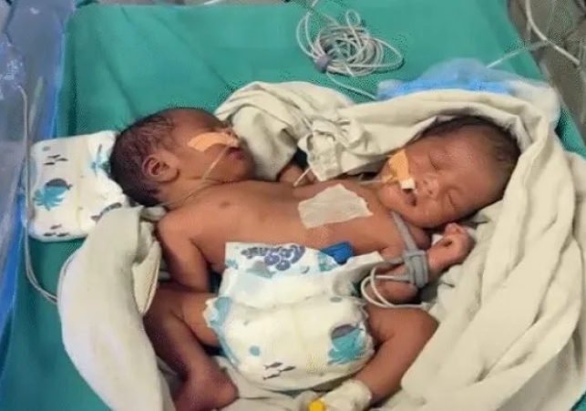 Miraculous Birth in Indore: Baby Born with Two Heads