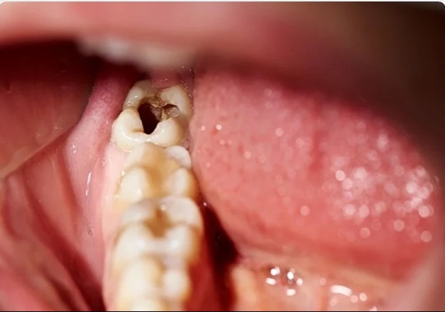 Cavity in teeth 