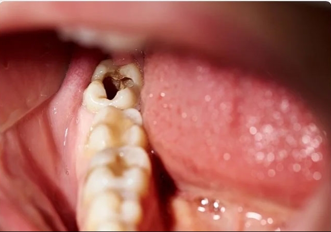 Cavity in teeth