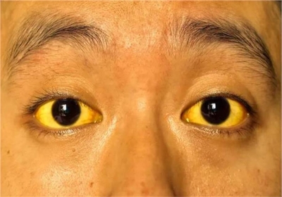 Jaundice Blast in Gohar