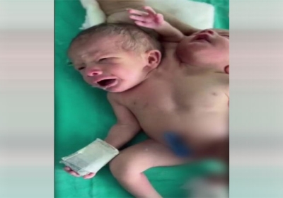 A woman gave birth to a baby having two heads and three hands in Ratlam Madhya Pradesh 
