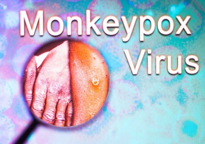 MonkeyPox Name change