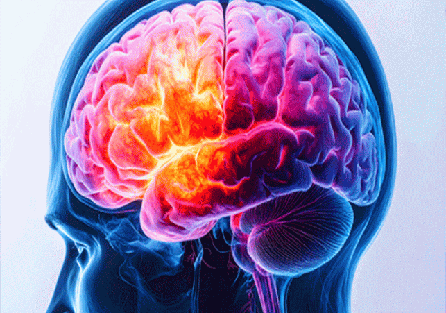 Vascular dementia a major problem, microplastics cause brain damage