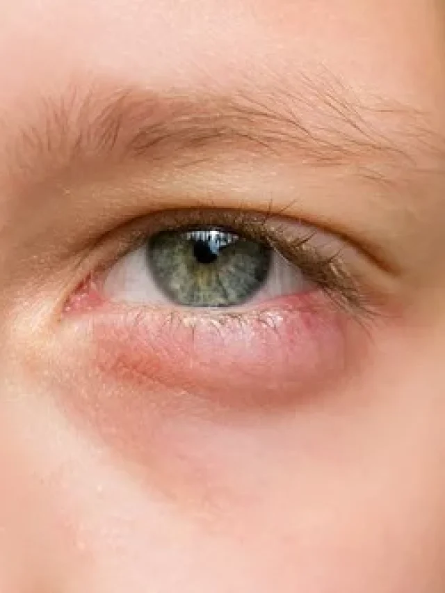 आंखों की सूजन को झट से दूर कर सकते हैं ये घरेलू उपाय।
